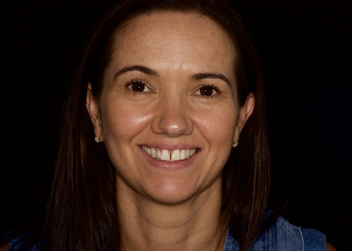 The Million Dollar Smile - Before