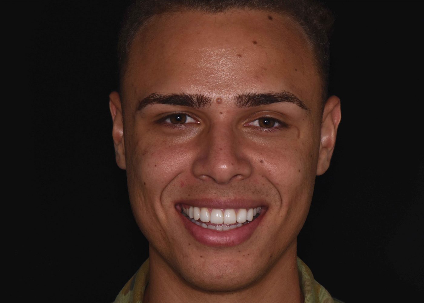 Gummy Smile Correction - After