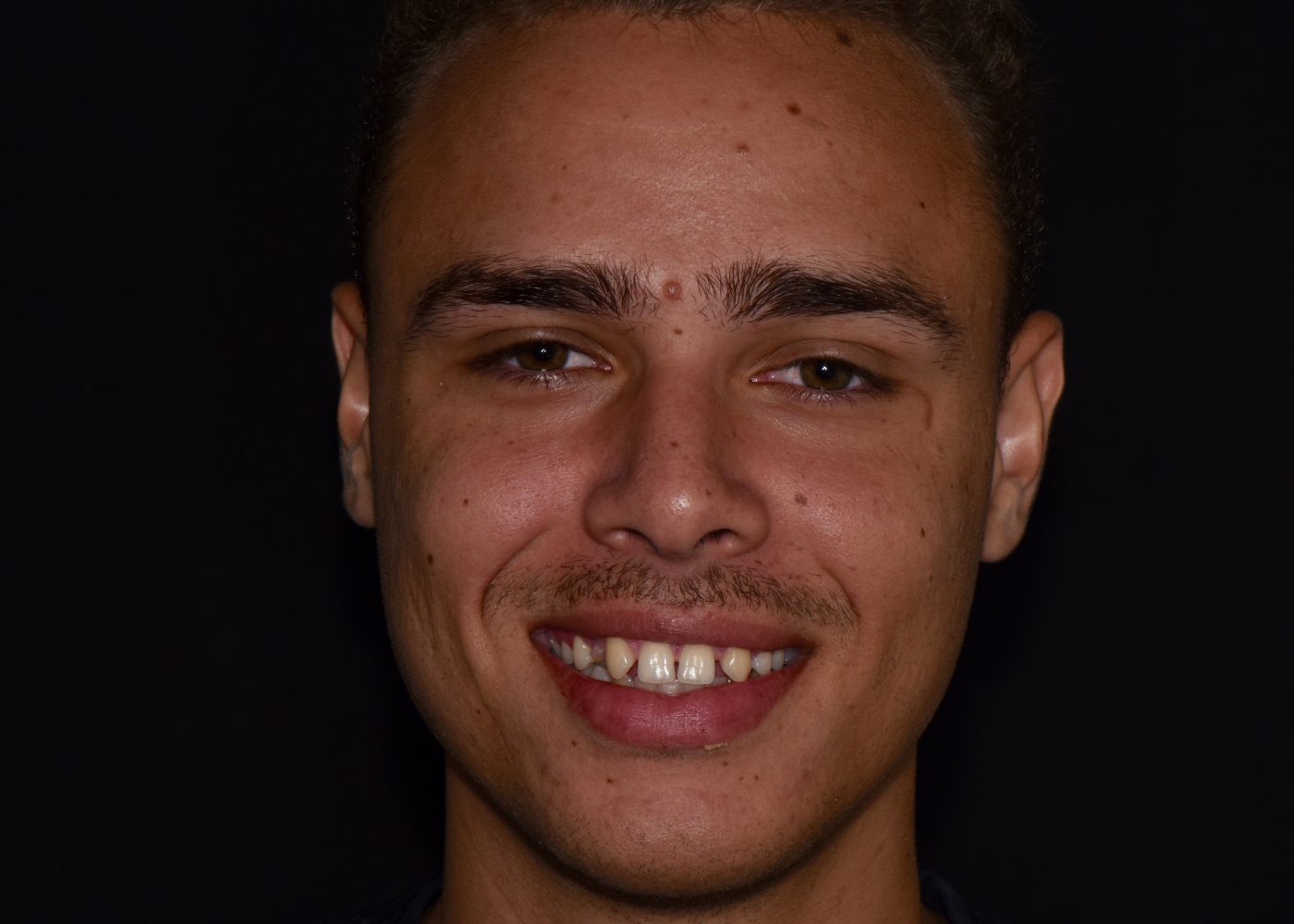 Gummy Smile Correction - Before