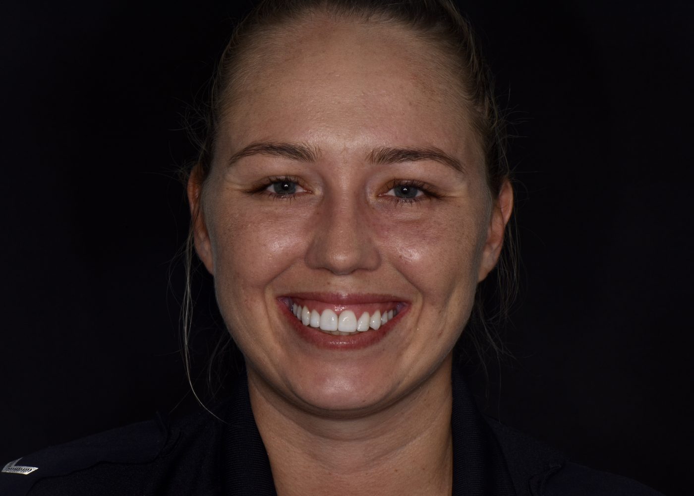 Full Mouth Rehabilitation - After