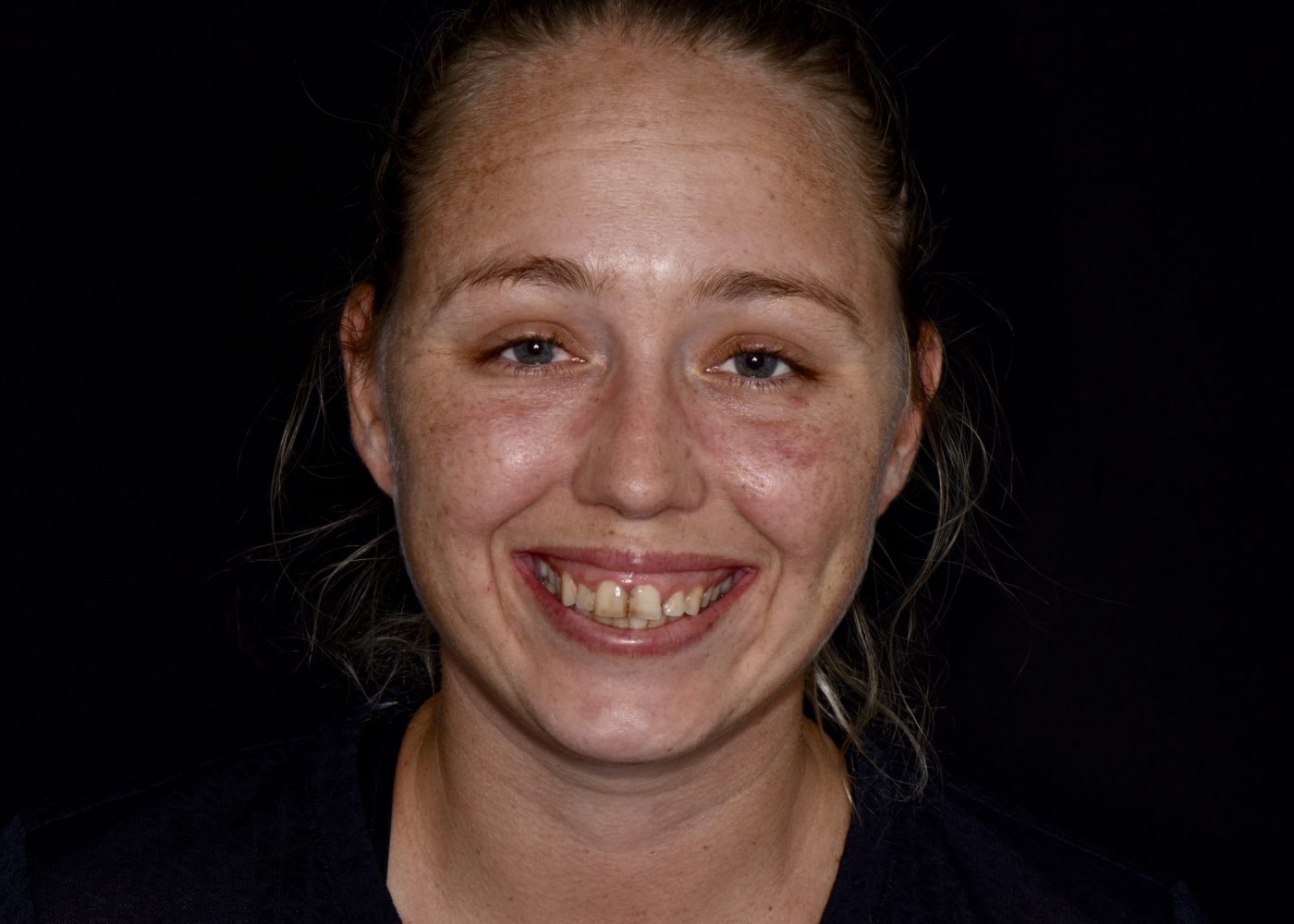 Full Mouth Rehabilitation - Before