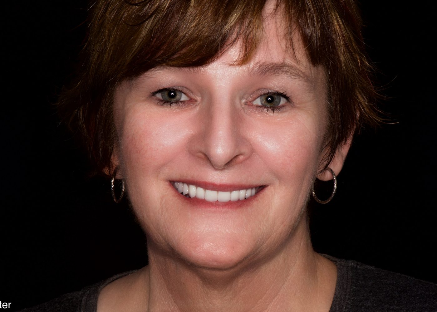 Smile Rejuvenation - After