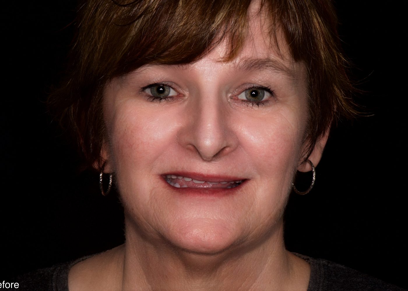 Smile Rejuvenation - Before