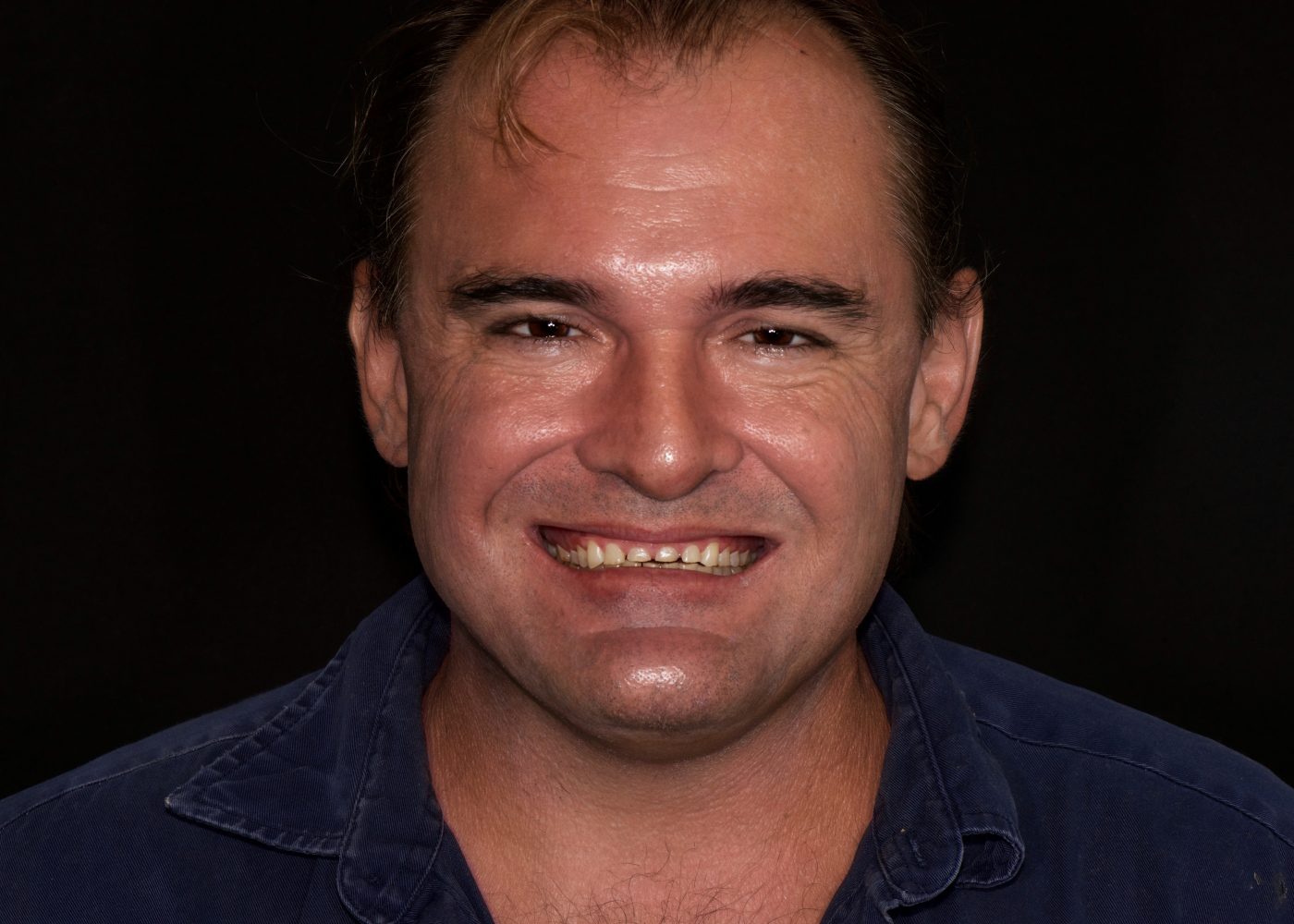 Crown Restoration - Before