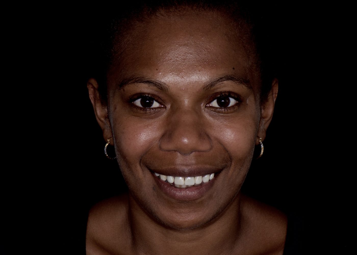 Functional Smile Improvement - After