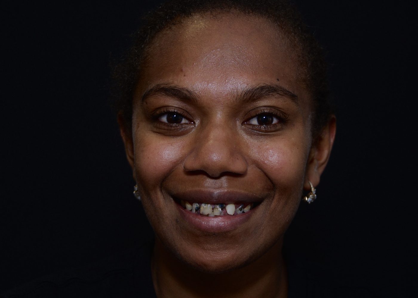 Functional Smile Improvement - Before